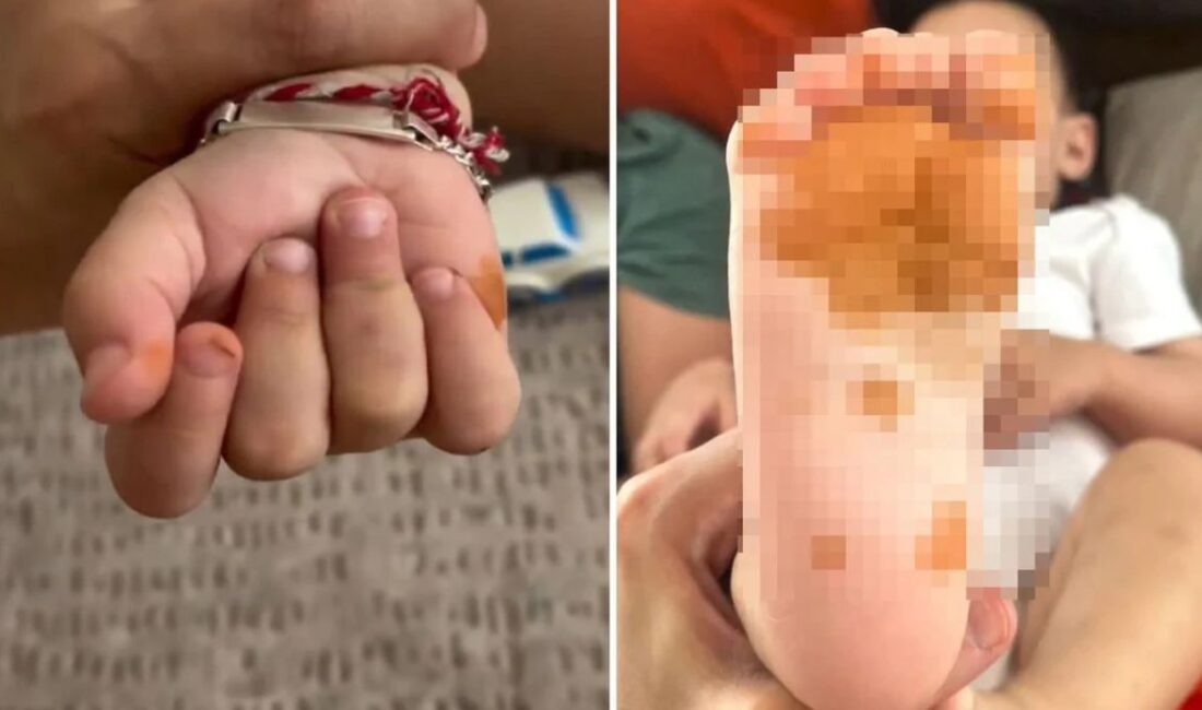 Sabah uyandığında çocuğunun el ve ayaklarında belirgin renk değişimi gören
