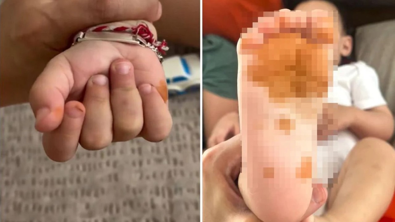 Sabah uyandığında çocuğunun el ve ayaklarında belirgin renk değişimi gören